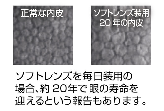 2.角膜内皮細胞の減少＝眼の寿命の目安…年に1度の目安で変化を確認しましょう。