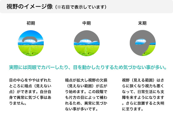 緑内障のタイプと症状