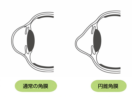 円錐角膜とは