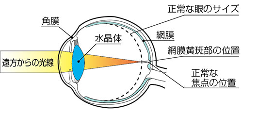 弱視を誘発する。