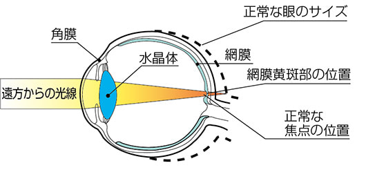 弱視を誘発する。